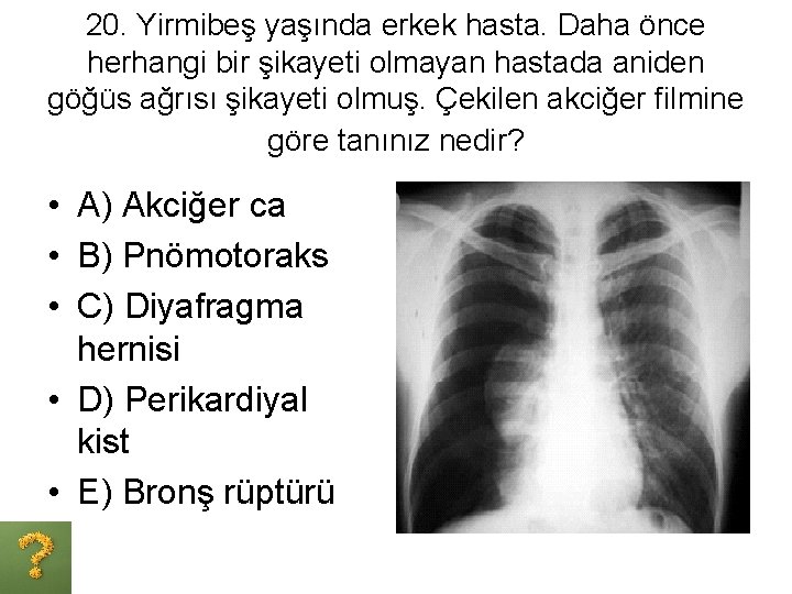 20. Yirmibeş yaşında erkek hasta. Daha önce herhangi bir şikayeti olmayan hastada aniden göğüs