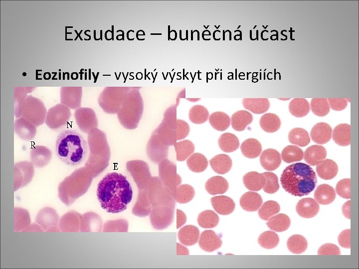 Exsudace – buněčná účast • Eozinofily – vysoký výskyt při alergiích Exsudace – buněčná účast • Eozinofily – vysoký výskyt při alergiích