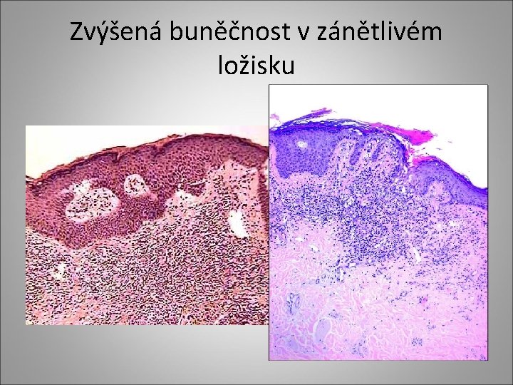 Zvýšená buněčnost v zánětlivém ložisku Zvýšená buněčnost v zánětlivém ložisku