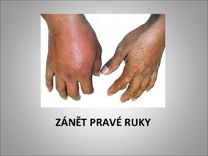 ZÁNĚT PRAVÉ RUKY ZÁNĚT PRAVÉ RUKY