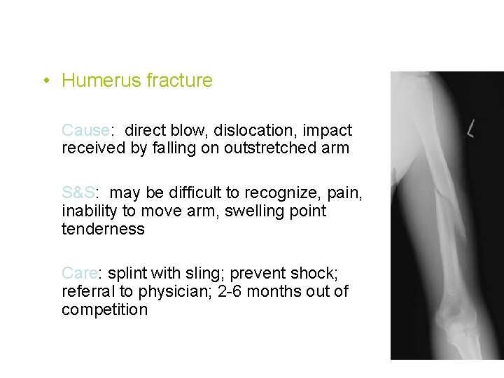 • Humerus fracture Cause: direct blow, dislocation, impact received by falling on outstretched • Humerus fracture Cause: direct blow, dislocation, impact received by falling on outstretched