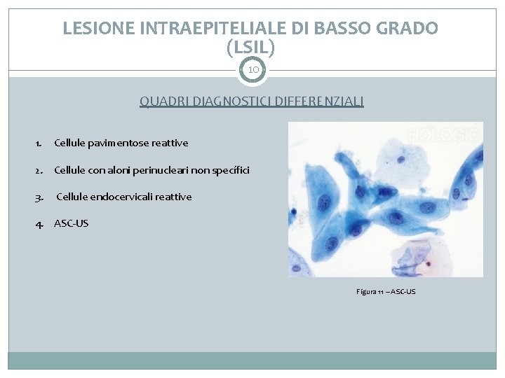 LESIONE INTRAEPITELIALE DI BASSO GRADO (LSIL) 10 QUADRI DIAGNOSTICI DIFFERENZIALI 1. Cellule pavimentose reattive