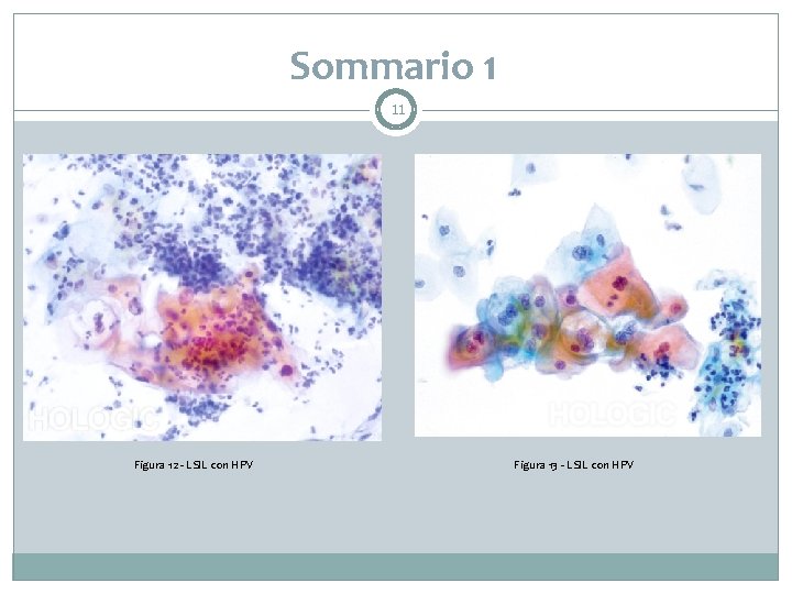 Sommario 1 11 Figura 12 - LSIL con HPV Figura 13 - LSIL con