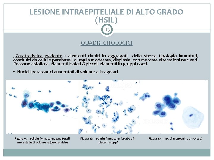 LESIONE INTRAEPITELIALE DI ALTO GRADO (HSIL) 13 QUADRI CITOLOGICI Caratteristica evidente : elementi riuniti