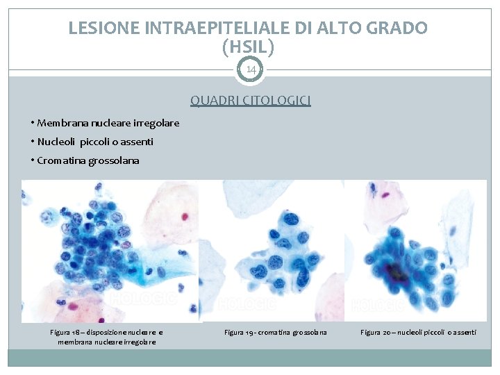 LESIONE INTRAEPITELIALE DI ALTO GRADO (HSIL) 14 QUADRI CITOLOGICI • Membrana nucleare irregolare •