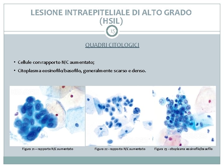 LESIONE INTRAEPITELIALE DI ALTO GRADO (HSIL) 15 QUADRI CITOLOGICI • Cellule con rapporto N/C