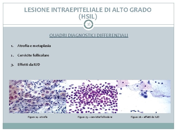 LESIONE INTRAEPITELIALE DI ALTO GRADO (HSIL) 16 QUADRI DIAGNOSTICI DIFFERENZIALI 1. Atrofia e metaplasia