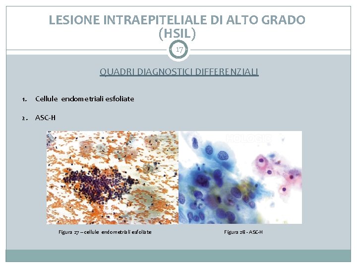 LESIONE INTRAEPITELIALE DI ALTO GRADO (HSIL) 17 QUADRI DIAGNOSTICI DIFFERENZIALI 1. Cellule endometriali esfoliate