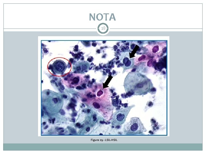 NOTA 18 Figura 29 - LSIL-HSIL 