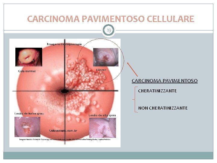 CARCINOMA PAVIMENTOSO CELLULARE 19 CARCINOMA PAVIMENTOSO CHERATINIZZANTE NON CHERATINIZZANTE 