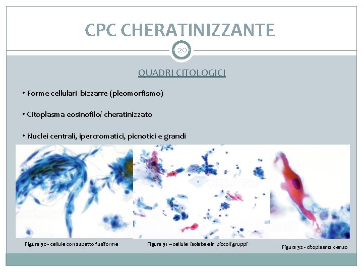 CPC CHERATINIZZANTE 20 QUADRI CITOLOGICI • Forme cellulari bizzarre (pleomorfismo) • Citoplasma eosinofilo/ cheratinizzato