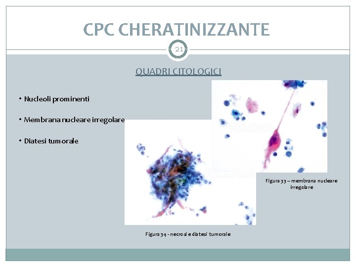 CPC CHERATINIZZANTE 21 QUADRI CITOLOGICI • Nucleoli prominenti • Membrana nucleare irregolare • Diatesi