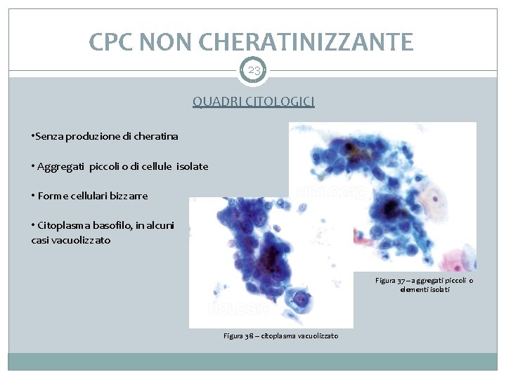 CPC NON CHERATINIZZANTE 23 QUADRI CITOLOGICI • Senza produzione di cheratina • Aggregati piccoli