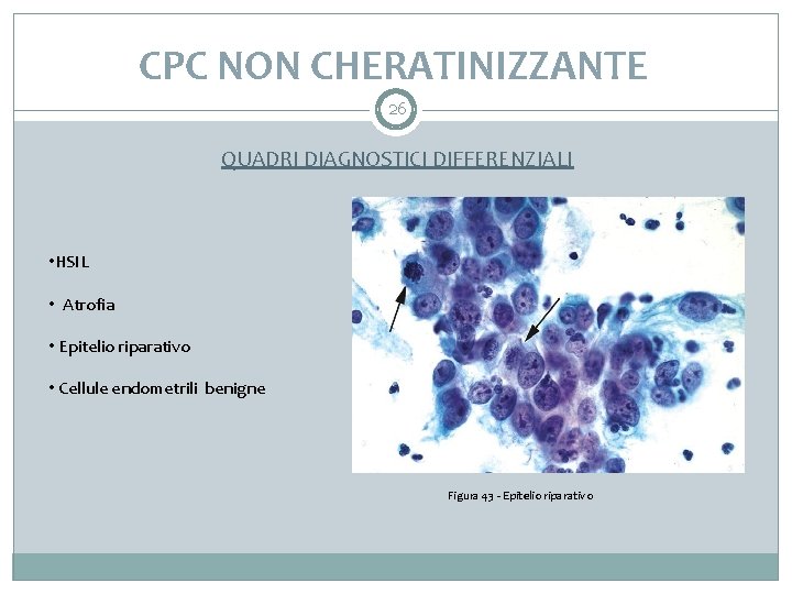 CPC NON CHERATINIZZANTE 26 QUADRI DIAGNOSTICI DIFFERENZIALI • HSIL • Atrofia • Epitelio riparativo