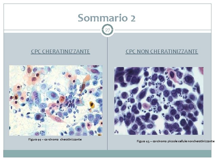Sommario 2 27 CPC CHERATINIZZANTE Figura 44 – carcinoma cheratinizzante CPC NON CHERATINIZZANTE Figura