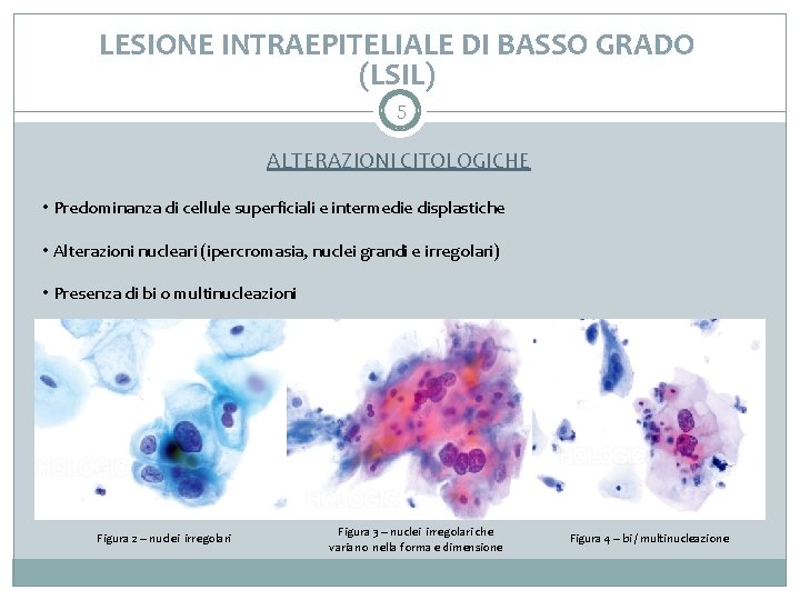 LESIONE INTRAEPITELIALE DI BASSO GRADO (LSIL) 5 ALTERAZIONI CITOLOGICHE • Predominanza di cellule superficiali