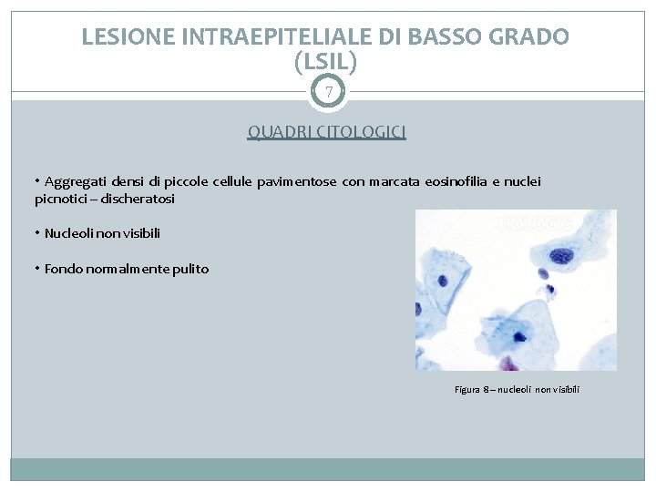 LESIONE INTRAEPITELIALE DI BASSO GRADO (LSIL) 7 QUADRI CITOLOGICI • Aggregati densi di piccole