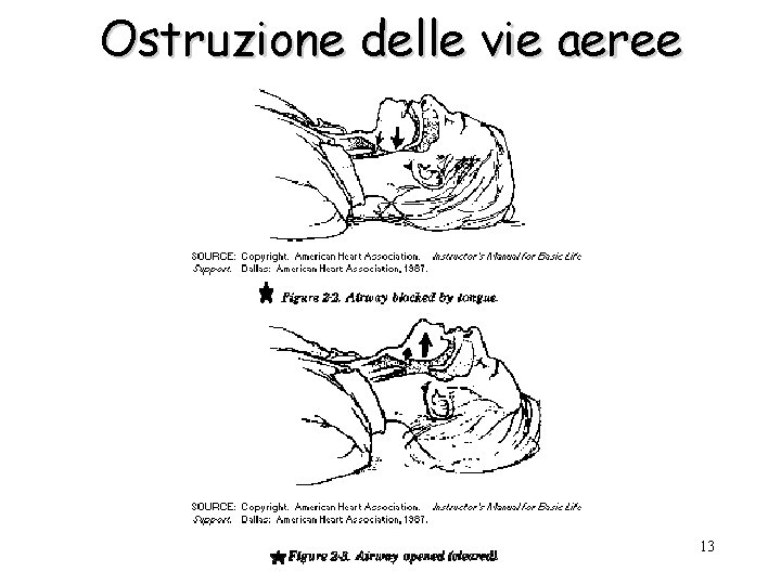 Ostruzione delle vie aeree 13 