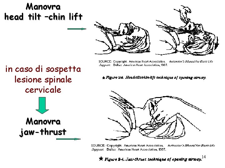 Manovra head tilt –chin lift in caso di sospetta lesione spinale cervicale Manovra jaw-thrust