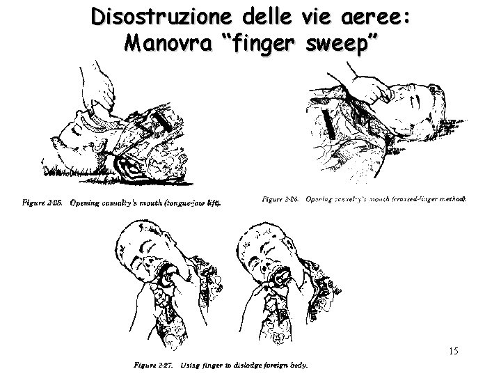 Disostruzione delle vie aeree: Manovra “finger sweep” 15 