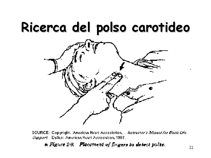 Ricerca del polso carotideo 22 
