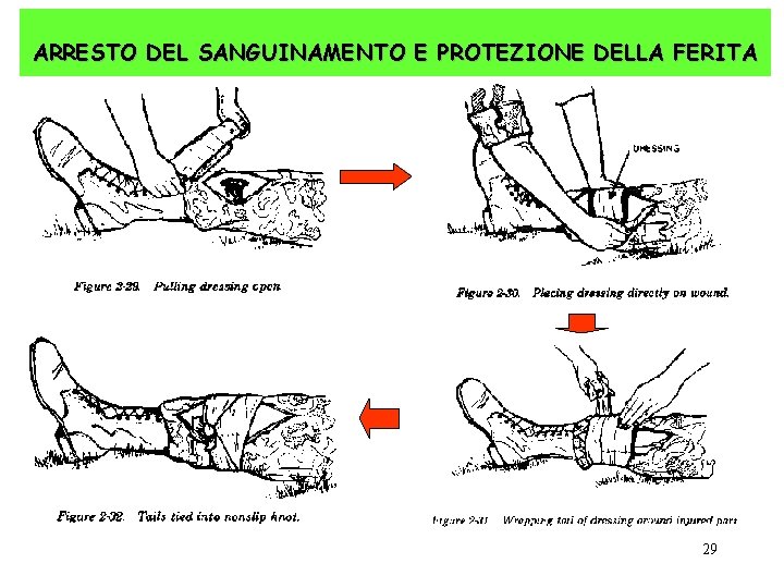 ARRESTO DEL SANGUINAMENTO E PROTEZIONE DELLA FERITA 29 