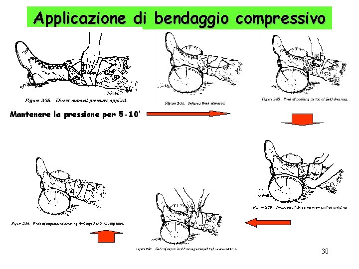 Applicazione di bendaggio compressivo Mantenere la pressione per 5 -10’ 30 