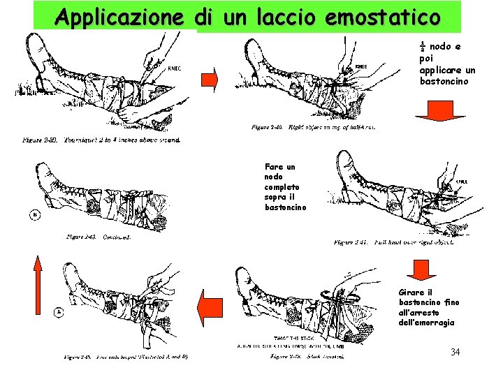 Applicazione di un laccio emostatico ½ nodo e poi applicare un bastoncino Fare un