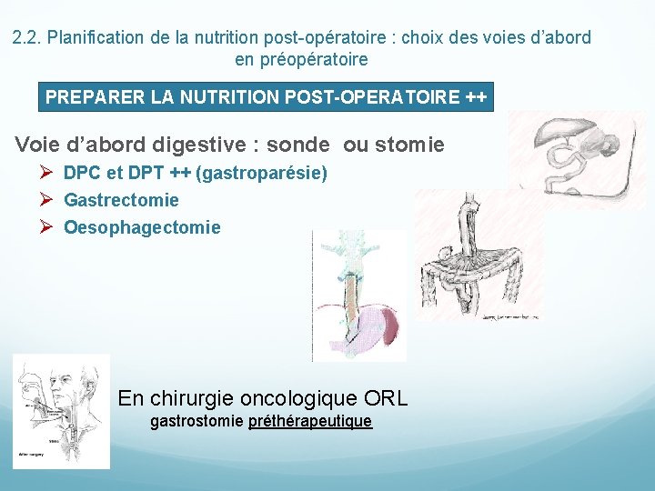 2. 2. Planification de la nutrition post-opératoire : choix des voies d’abord en préopératoire