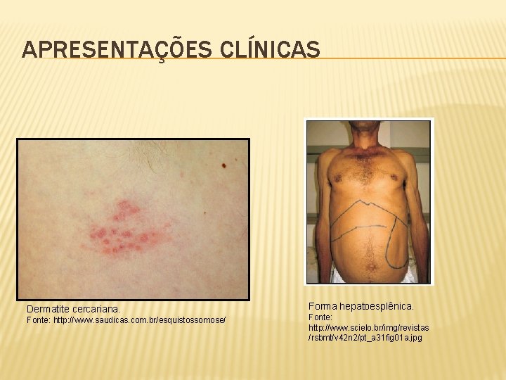 APRESENTAÇÕES CLÍNICAS Dermatite cercariana. Fonte: http: //www. saudicas. com. br/esquistossomose/ Forma hepatoesplênica. Fonte: http: