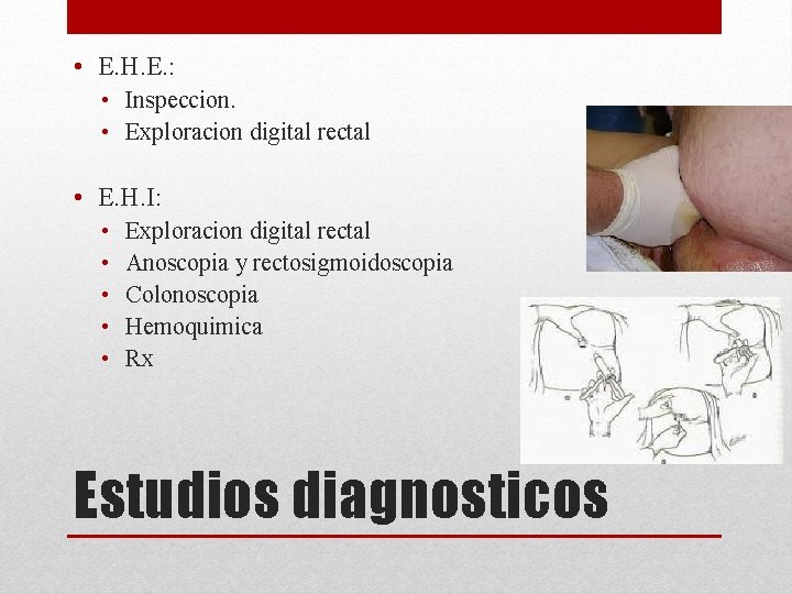  • E. H. E. : • Inspeccion. • Exploracion digital rectal • E.