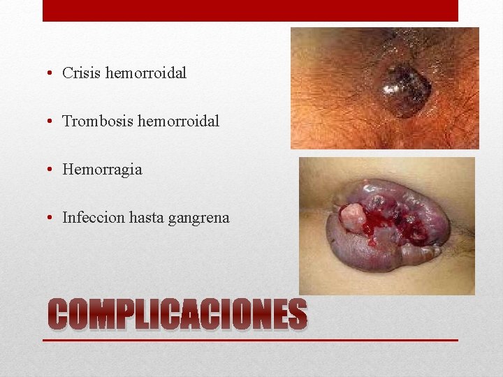  • Crisis hemorroidal • Trombosis hemorroidal • Hemorragia • Infeccion hasta gangrena COMPLICACIONES