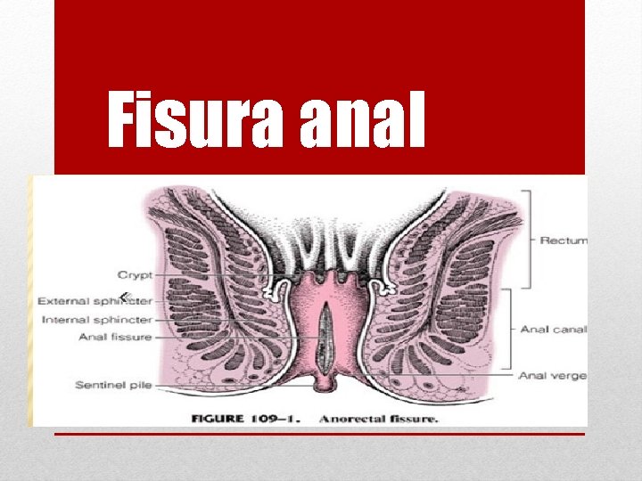 Fisura anal 