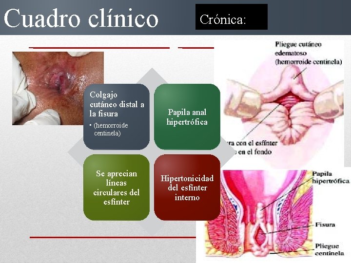 Cuadro clínico Colgajo cutáneo distal a la fisura • (hemorroide centinela) Se aprecian líneas