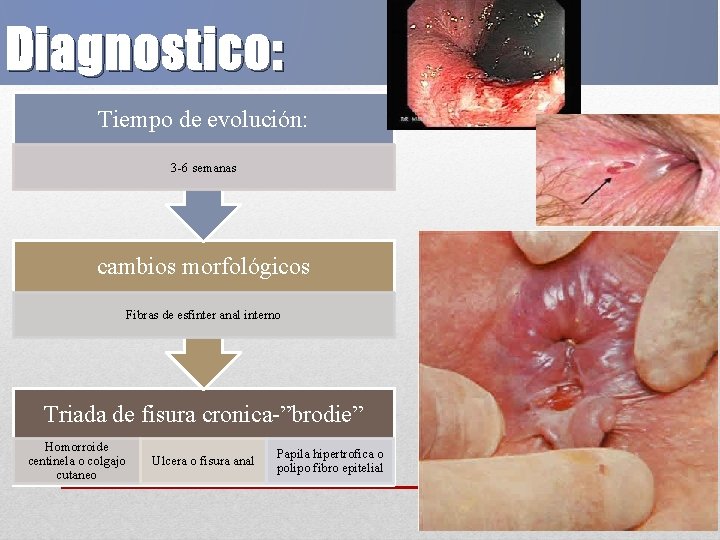 Diagnostico: Tiempo de evolución: 3 -6 semanas cambios morfológicos Fibras de esfinter anal interno