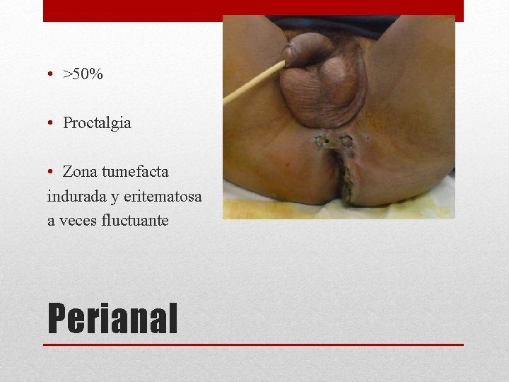  • >50% • Proctalgia • Zona tumefacta indurada y eritematosa a veces fluctuante