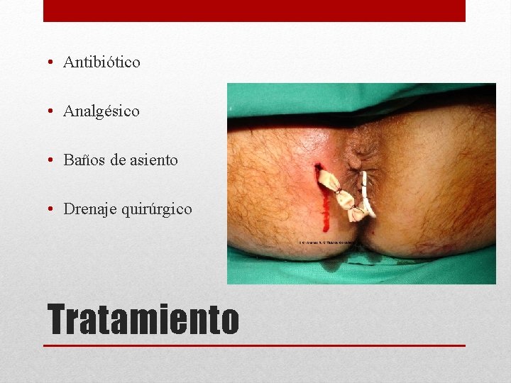  • Antibiótico • Analgésico • Baños de asiento • Drenaje quirúrgico Tratamiento 