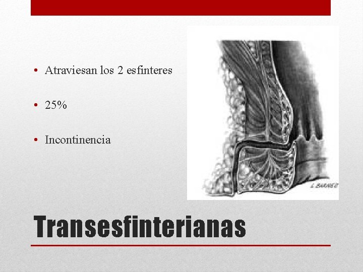  • Atraviesan los 2 esfinteres • 25% • Incontinencia Transesfinterianas 