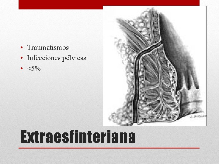  • Traumatismos • Infecciones pélvicas • <5% Extraesfinteriana 