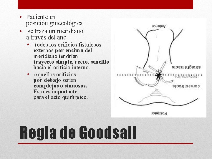  • Paciente en posición ginecológica • se traza un meridiano a través del