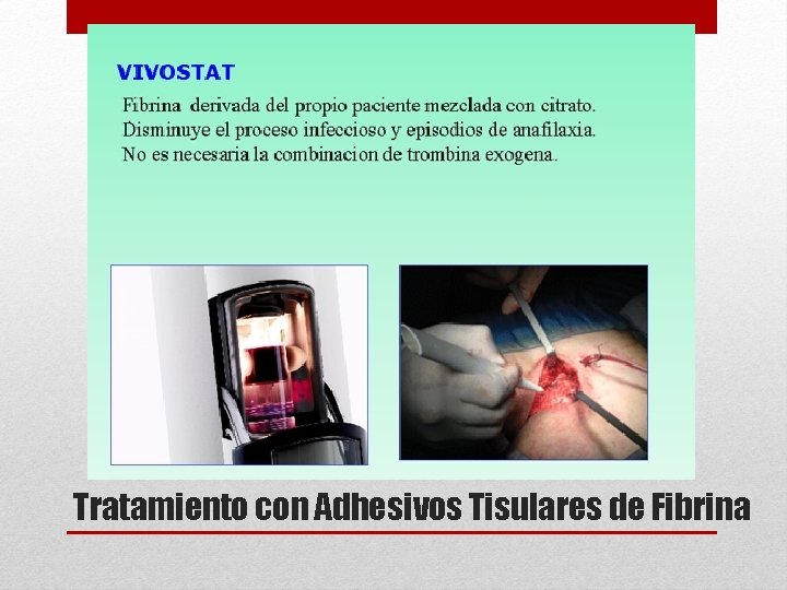 Tratamiento con Adhesivos Tisulares de Fibrina 