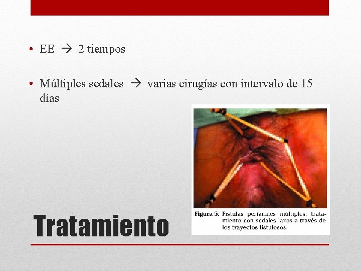  • EE 2 tiempos • Múltiples sedales varias cirugías con intervalo de 15