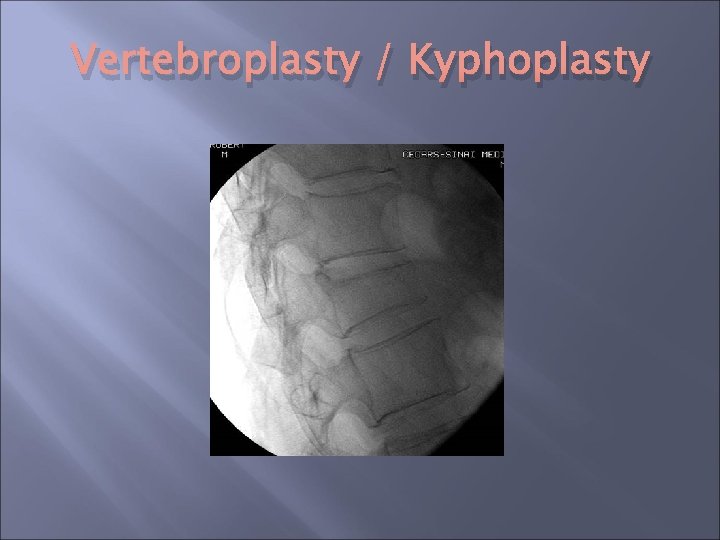 Vertebroplasty / Kyphoplasty Vertebroplasty / Kyphoplasty