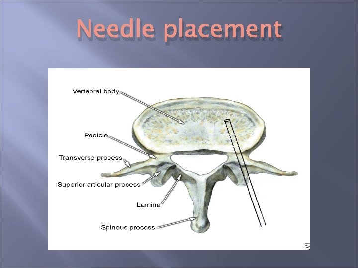 Needle placement Needle placement