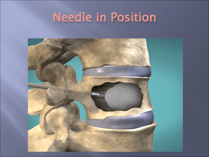 Needle in Position Needle in Position