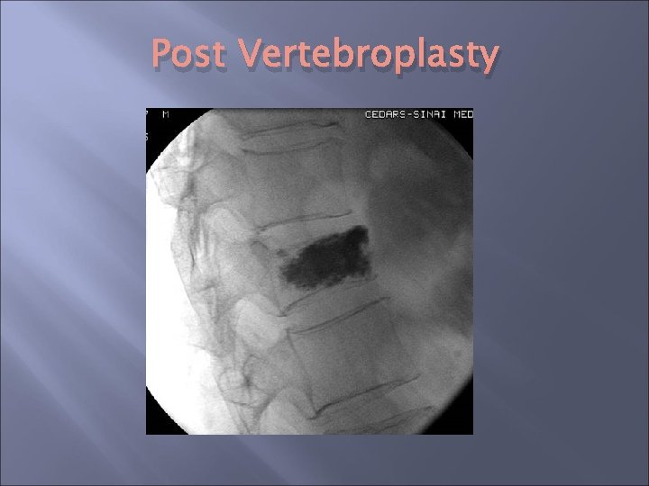 Post Vertebroplasty Post Vertebroplasty