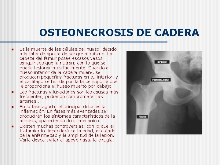 OSTEONECROSIS DE CADERA n n Es la muerte de las células del hueso, debido