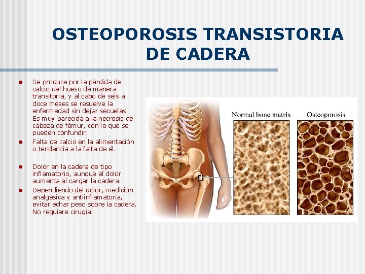 OSTEOPOROSIS TRANSISTORIA DE CADERA n n Se produce por la pérdida de calcio del