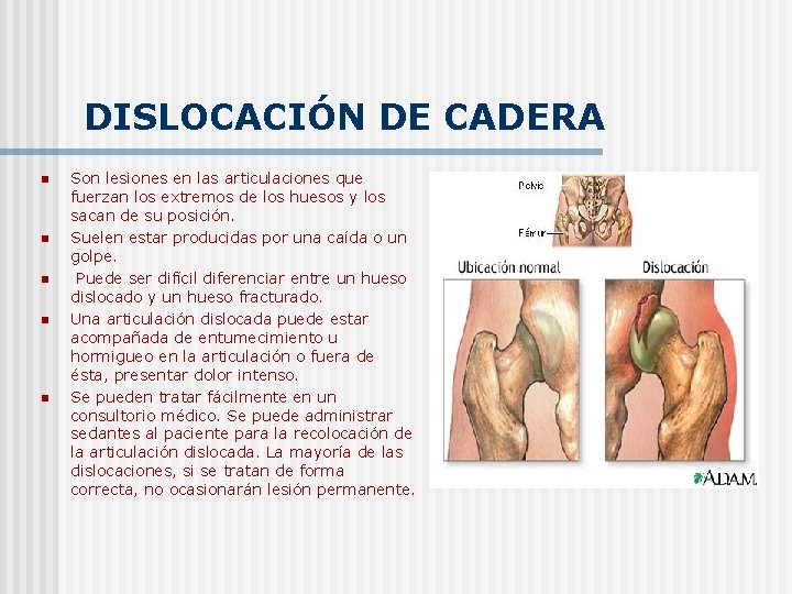 DISLOCACIÓN DE CADERA n n n Son lesiones en las articulaciones que fuerzan los