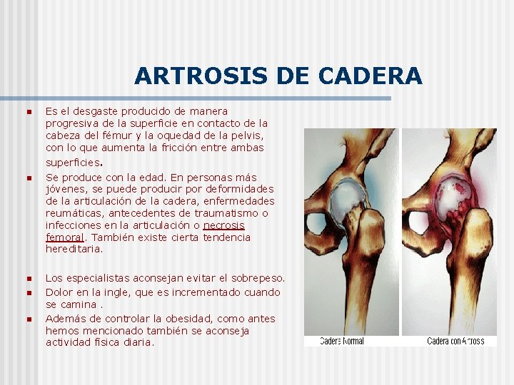 ARTROSIS DE CADERA n n n Es el desgaste producido de manera progresiva de